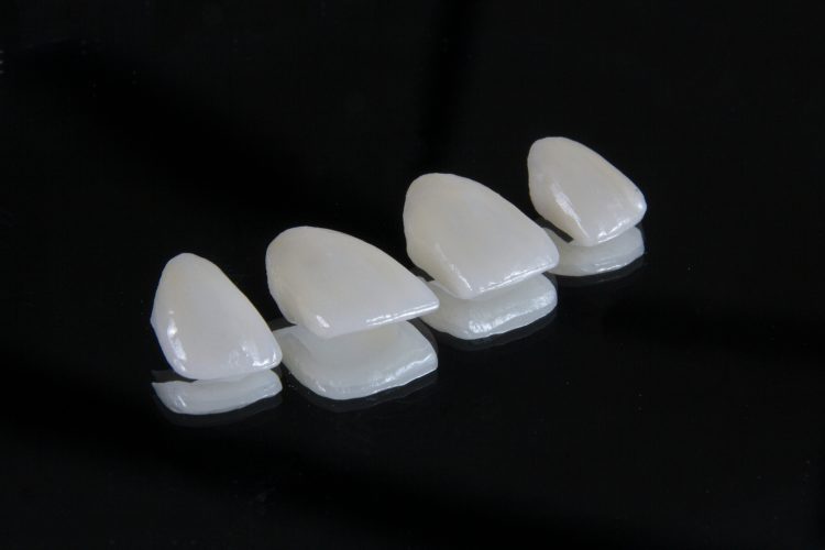 Dental Veneers at Iver Dental Practice